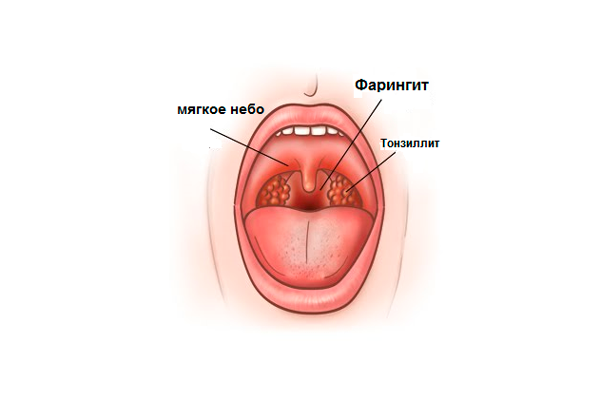 [Игорь Атрощенко] Диагностика и лечение тонзиллито_0.png